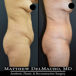 Before-After-4-Months-–-Lipo-Abdominoplasty5