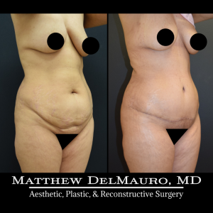 Before-After-4-Months-–-Lipo-Abdominoplasty6